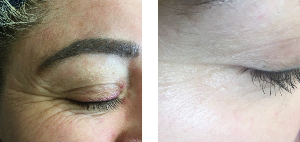 Botox photos