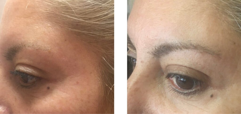 Botox photos2