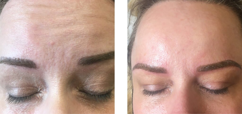 Botox photos3