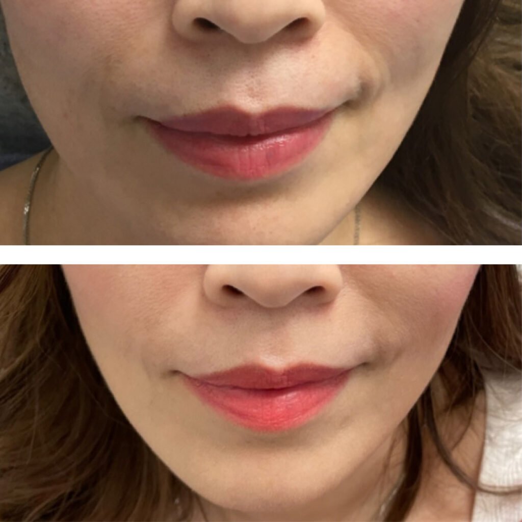 Facial dermall photos