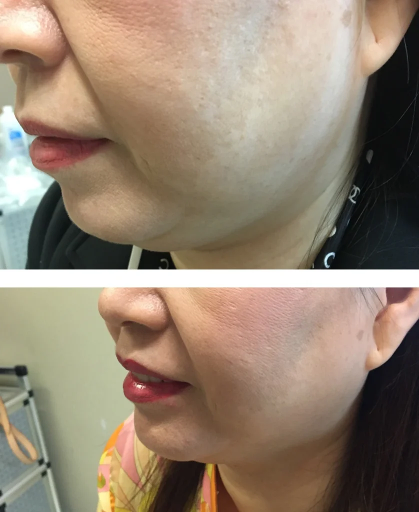 Kybella img 4957