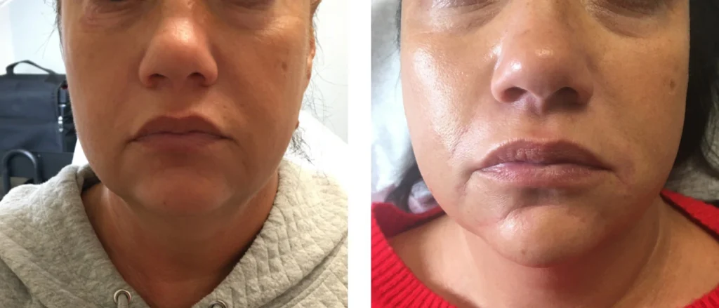Kybella img 6321
