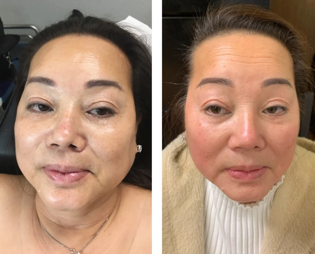 Kybella img 6322