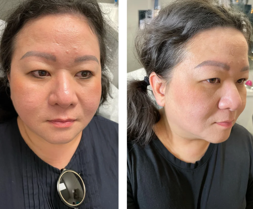 Kybella img 7956