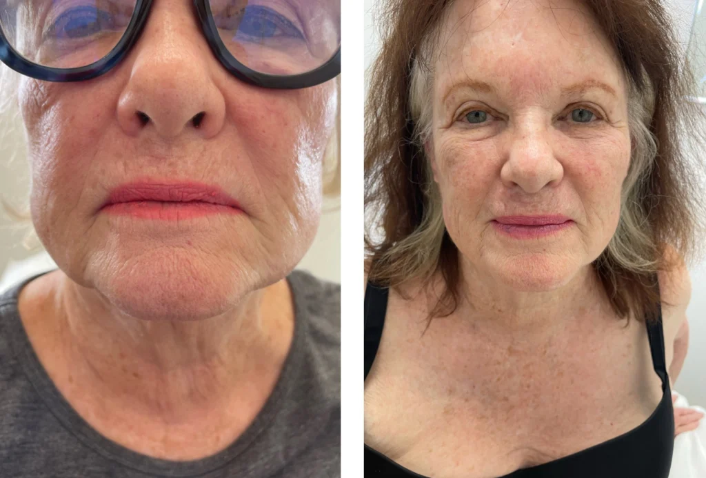 Kybella img 1434